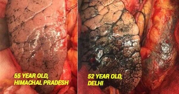 नसों में घुला ज़हर: वायु प्रदूषण हर तरह की बीमारी फैला रहा है और इसकी चोट शरीर का हर अंग पर है। फोटो – IndiaToday